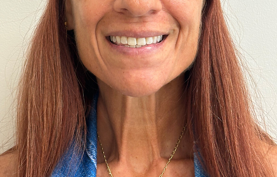 Invisalign Patient Smile After