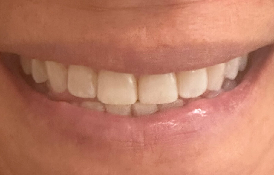 After Invisalign Closeup Smile