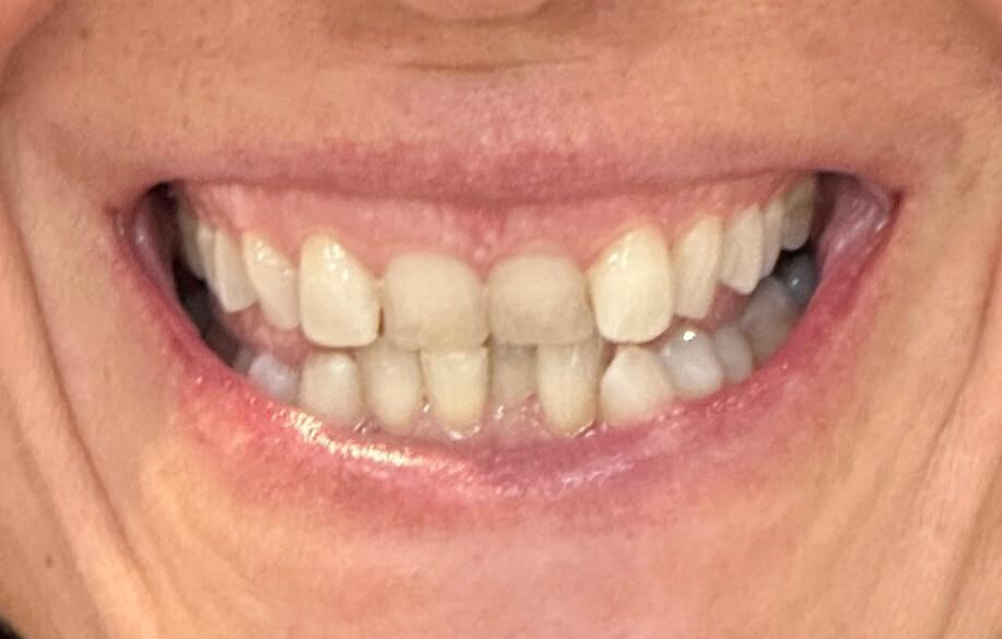 Before Invisalign Closeup Smile