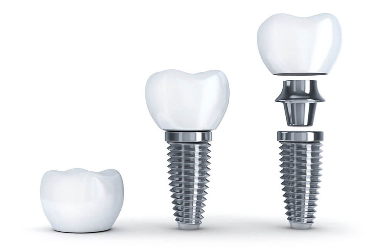 A Step by Step Guide to Dental Implants | Meridian Dental Group