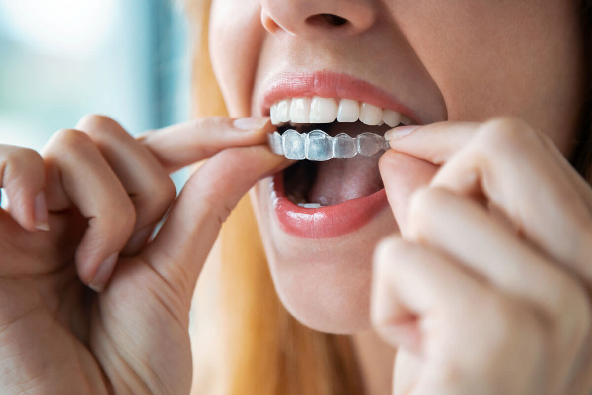 Invisalign Cost: Five Ways to Cover Expenses
