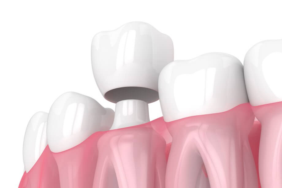 What Are Dental Crowns Made Of?